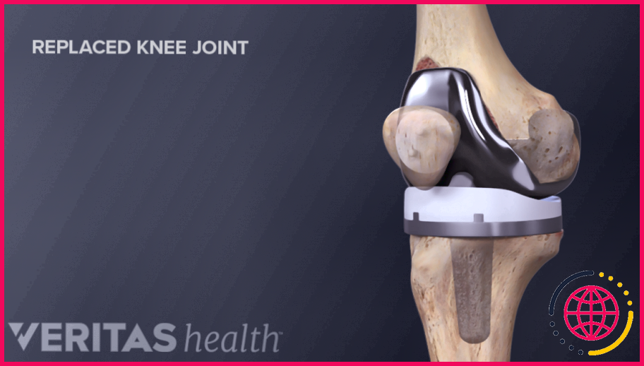 Combien de temps dure le rétablissement après une chirurgie du genou ?
