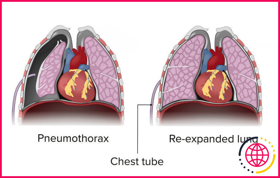 Comment la plèvre viscérale est-elle affectée par un pneumothorax ?
