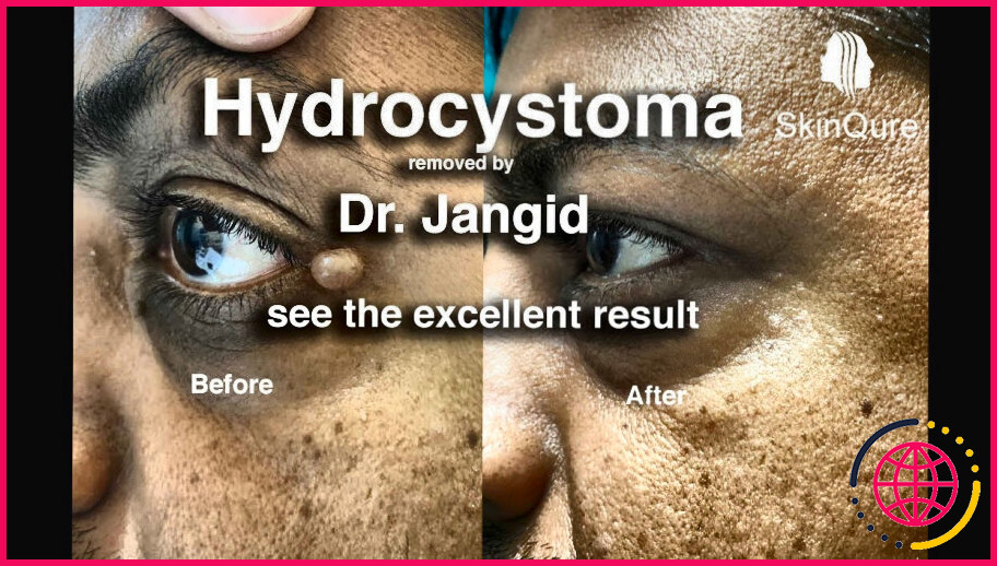 Comment se débarrasser d'un hidrocystome ?
