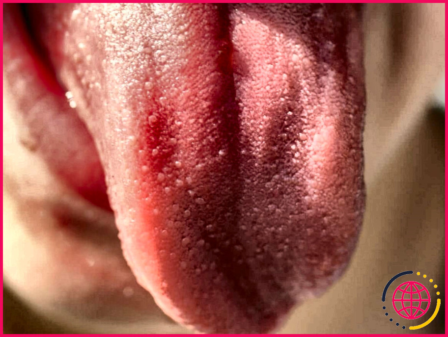 De quoi la langue fraise est-elle un symptôme ?
