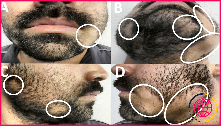 La pousse de la barbe est-elle liée à la calvitie ?
