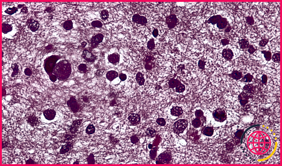 Quel est le taux de survie d'un astrocytome ?
