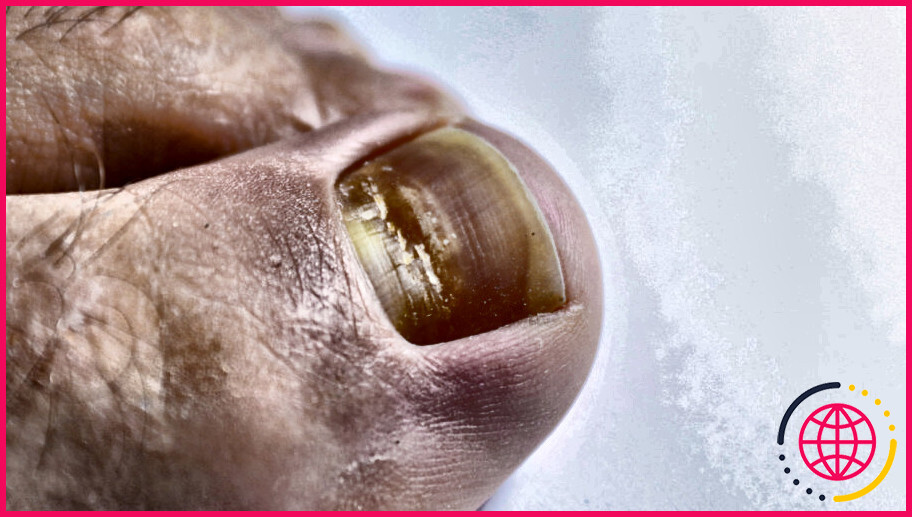 Quelles sont les causes des stries dans les ongles des pieds ?
