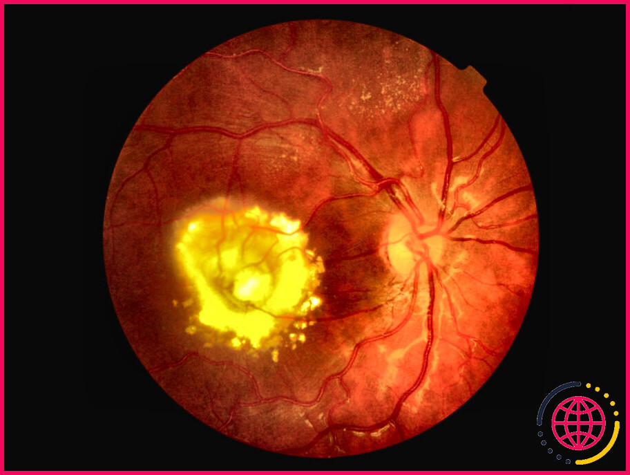 Qu'est-ce que la maladie de coats de l'œil ?
