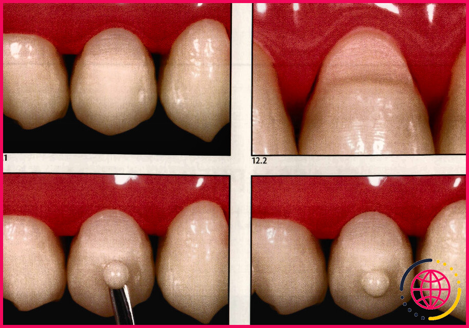 Qu'est-ce qu'une restauration de classe v en dentaire ?
