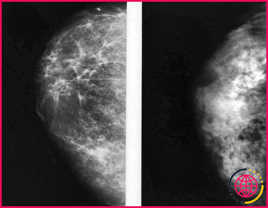 Toutes les grosseurs du sein apparaissent-elles sur les mammographies ?

