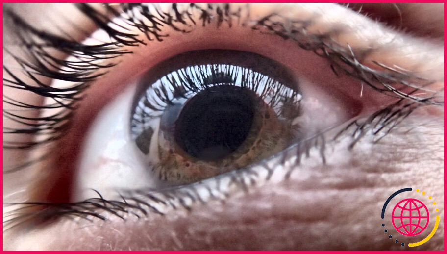 Combien de temps faut-il à l'œil pour se stabiliser après une opération de la cataracte ?
