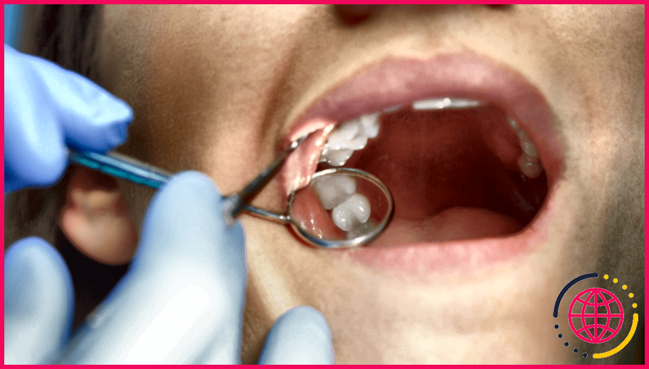 De quoi sont faits les scellants dentaires ?
