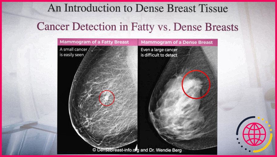 Que signifie indéterminé sur une mammographie ?
