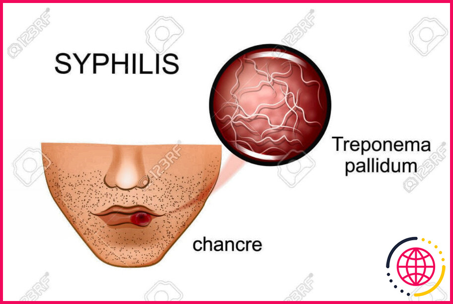 Quel est l'agent causal de la syphilis ?
