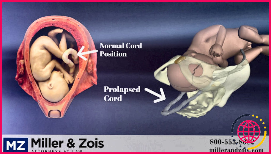 Quelle est la différence entre la présentation du cordon et le prolapsus du cordon ?
