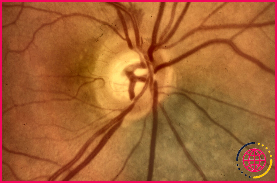 Quelles sont les causes de l'hémorragie du nerf optique ?
