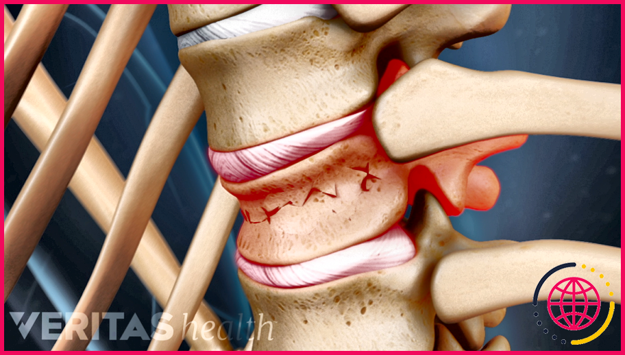 Quels sont les symptômes de l'ostéoporose de la colonne vertébrale ?
