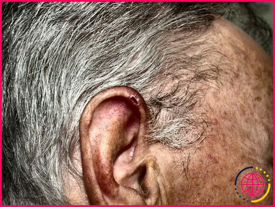 Qu'est-ce que la chondrite de l'oreille ?
