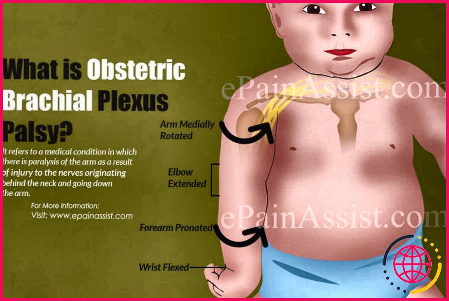 Qu'est-ce que la paralysie du plexus brachial ?
