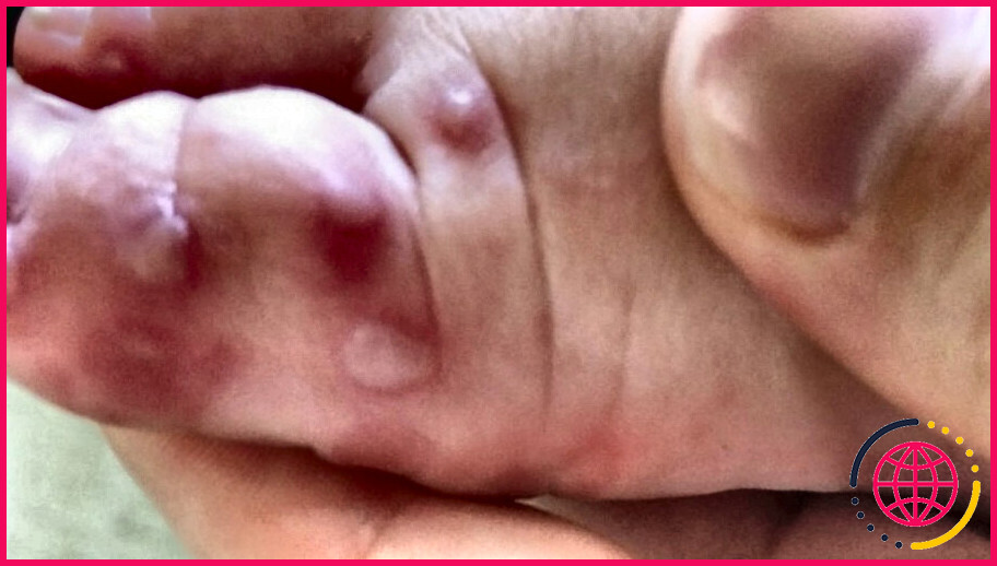 Est-ce la varicelle ou les mains, les pieds et la bouche ?

