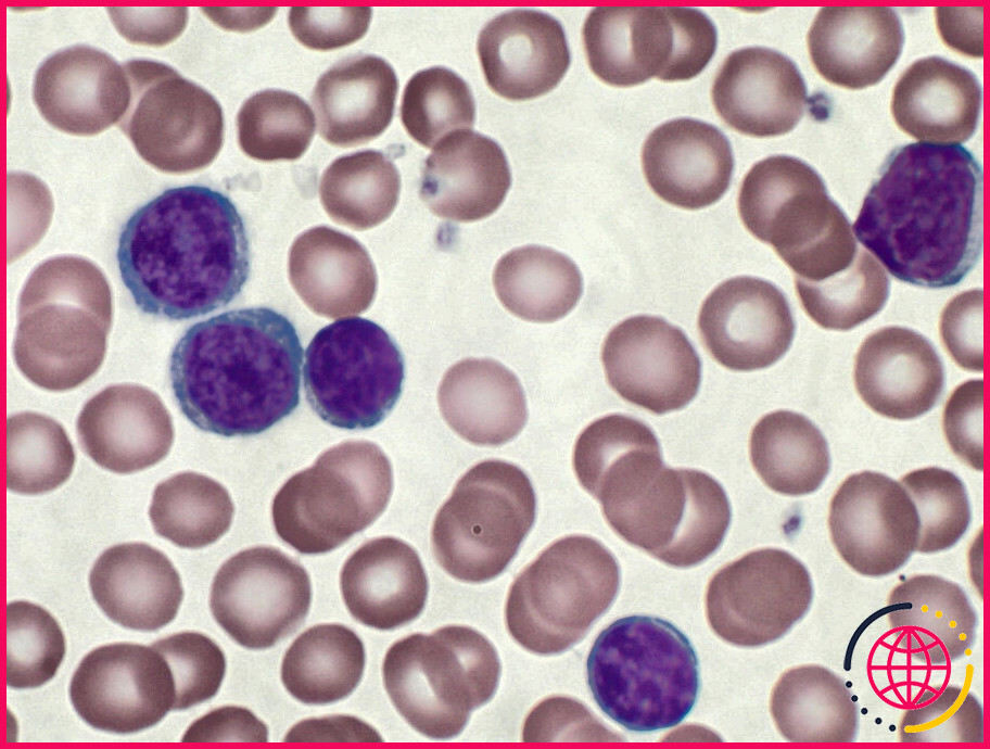 La lymphocytose monoclonale à cellules b est-elle un cancer ?
