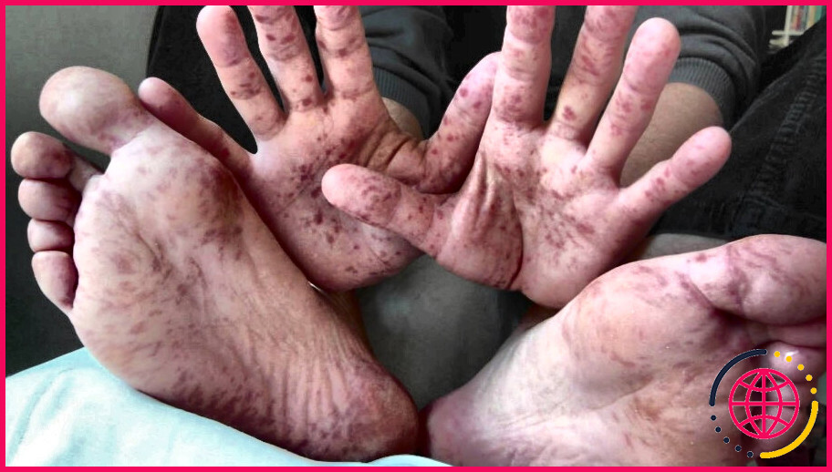 Peut-on avoir la varicelle sur les mains et les pieds ?
