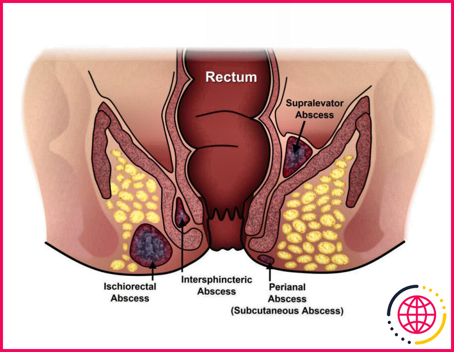 Qu'est-ce qu'un abcès intestinal ?
