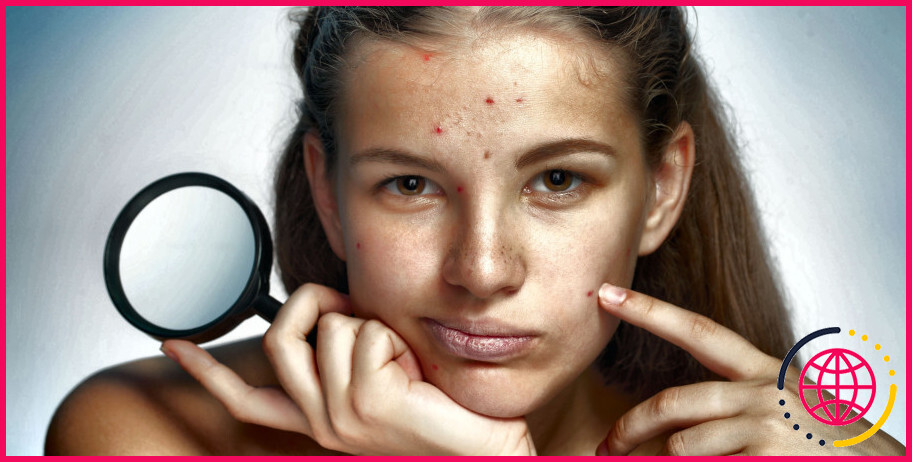 L'acide folique provoque-t-il de l'acné ?