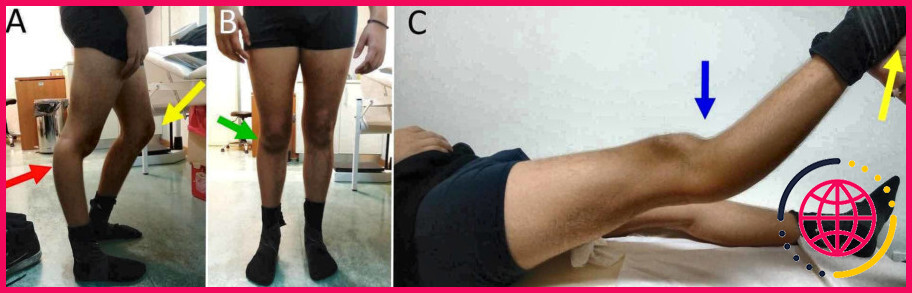 Comment faire une hyperextension du genou ?