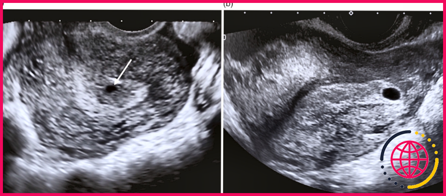 Le scanner peut-il détecter un début de grossesse ?