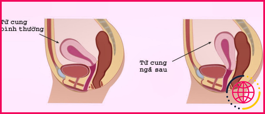 L'utérus rétroversé peut-il provoquer la constipation ?