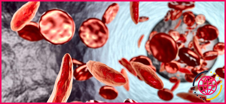Qu'est-ce qui est déformé dans la drépanocytose ?