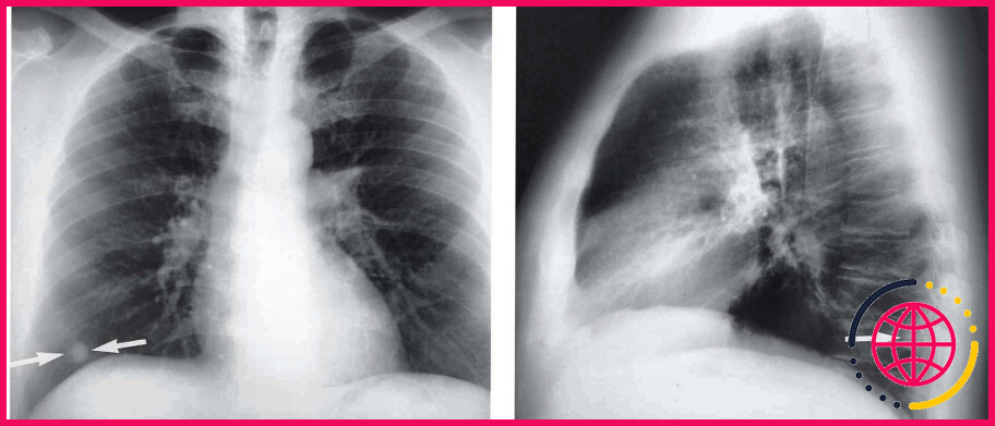 Qu'est-ce qu'un nodule pulmonaire ?