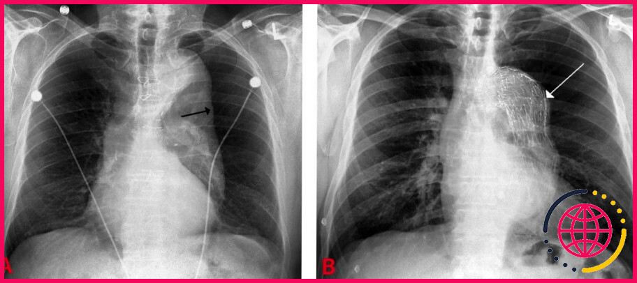 Une radiographie du thorax peut-elle montrer un anévrisme aortique ?