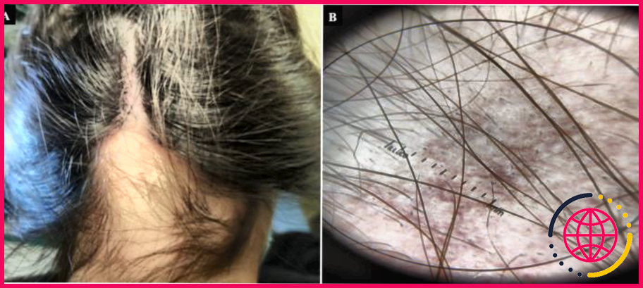 La maladie cœliaque entraîne-t-elle une perte de cheveux ?