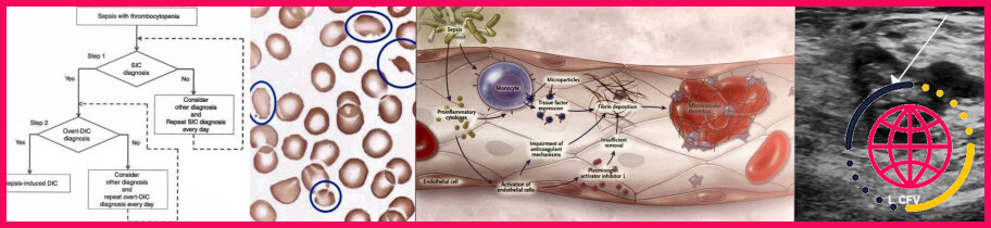 Les anticoagulants peuvent-ils provoquer une baisse des plaquettes ?