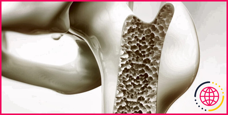 Les endocrinologues traitent-ils l'ostéoporose ?