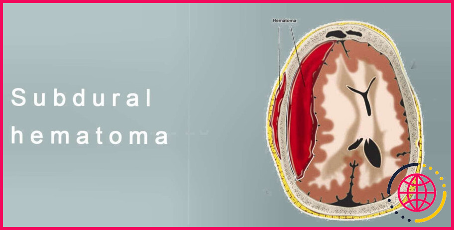 Pourquoi un hématome subdural est-il une blessure très grave ?