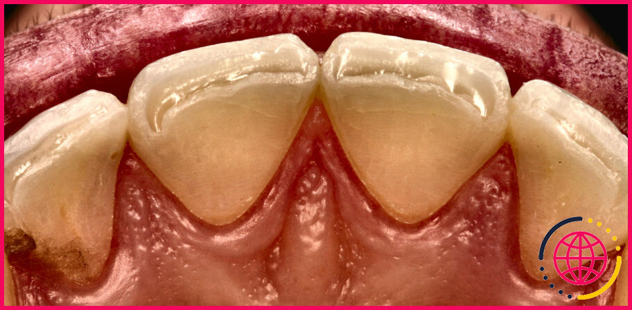 Quelles sont les dents maxillaires ?